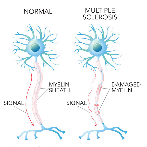 ms-nerve-cells